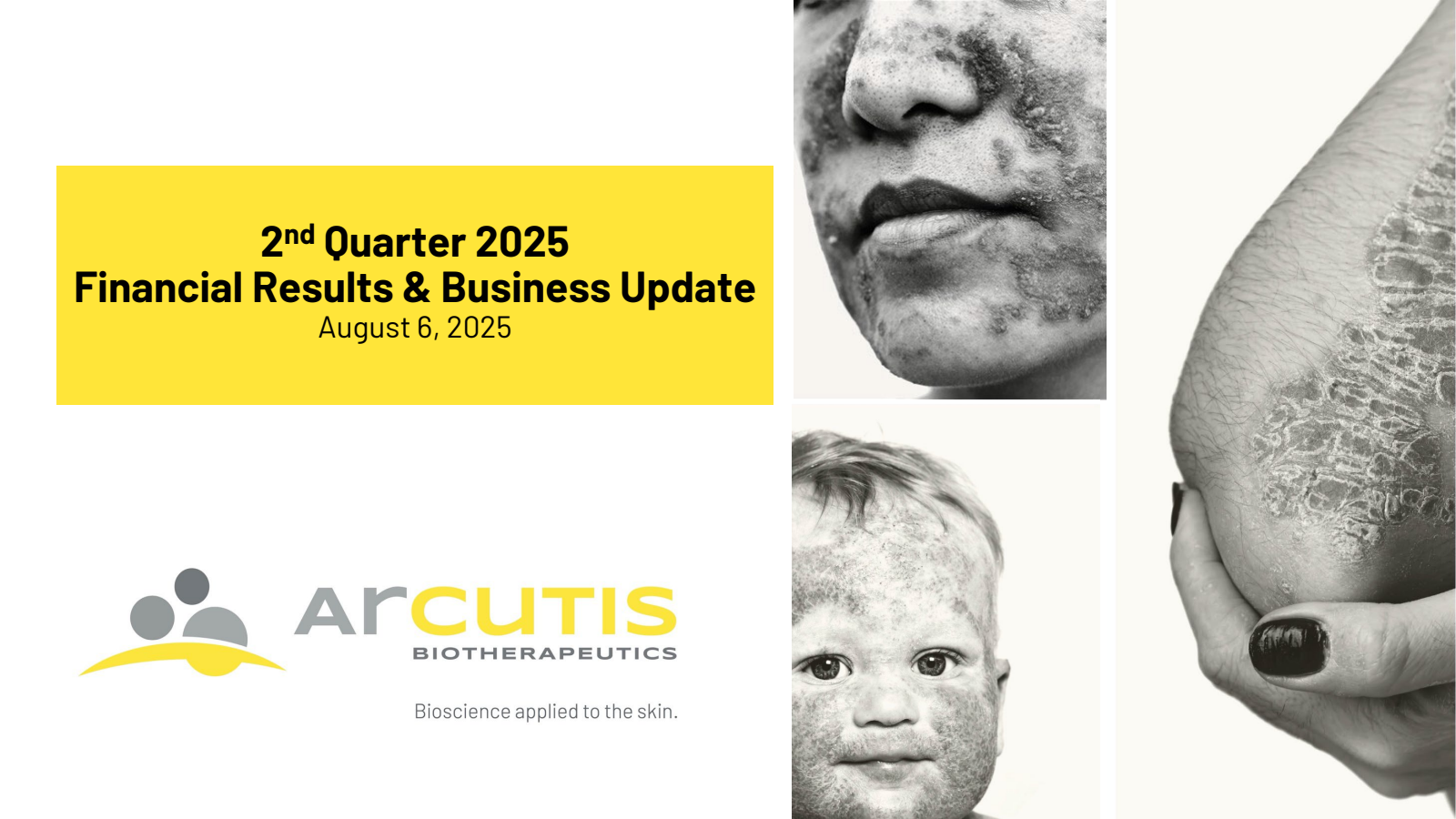 Arcutis Biotherapeutics' Q2 2025 Slide Deck